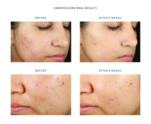InvisiScar Resurfacing Treatment - The Perfect Products